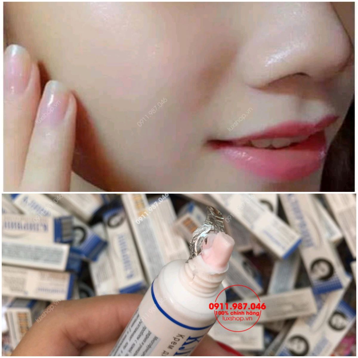 kem trị sẹo Nga, kem trị seo Klirvin, kem trị sẹo mụn, kem trị sẹo thâm