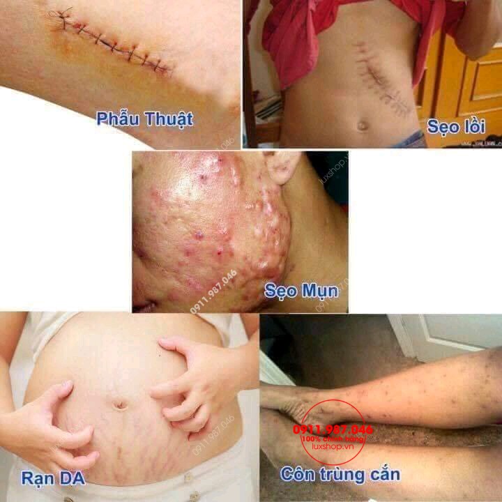 kem trị sẹo Nga, kem trị seo Klirvin, kem trị sẹo mụn, kem trị sẹo thâm