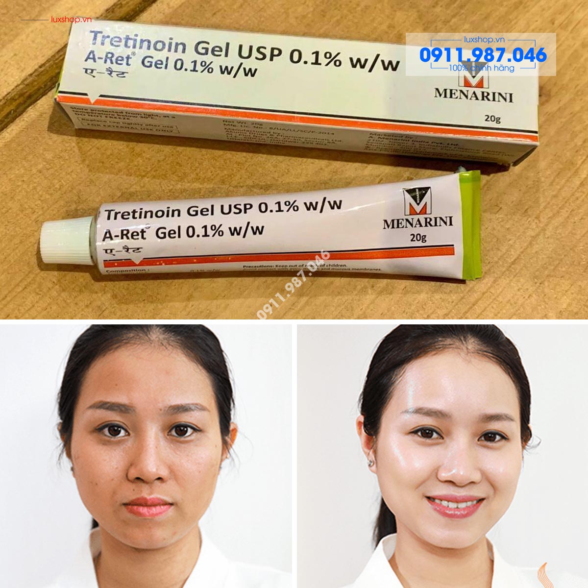 Tretinoin trị mụn và chống lão hóa Gel USP Aret 0.1% Menarini chính hãng (Ấn Độ)