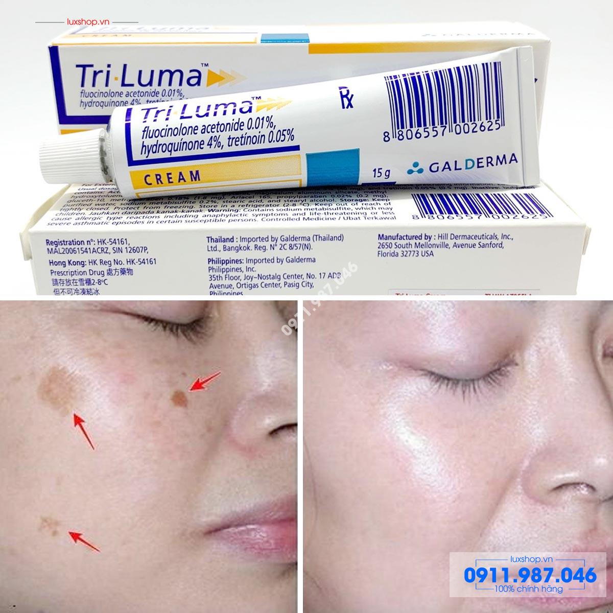 Thuốc Galderma Tri Luma Cream 15g trị thâm nám đốm nâu chính hãng (Mỹ)